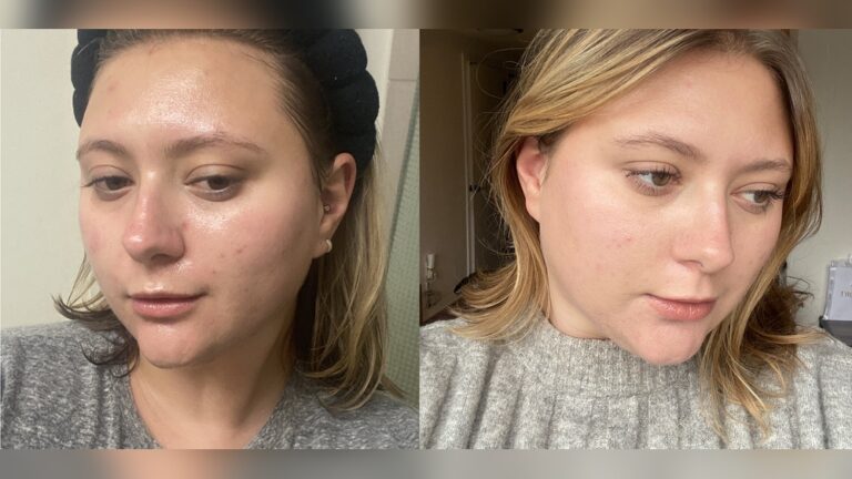 What is Slugging in Skincare