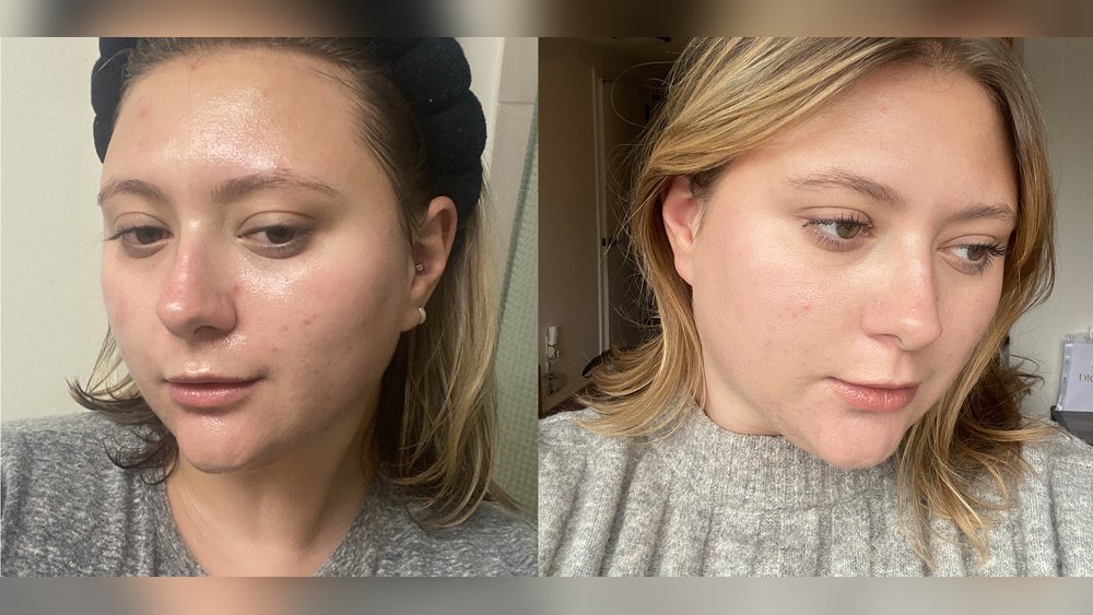 What is Slugging in Skincare