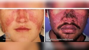 Why Cheeks Get Hot Suddenly