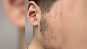 Why Do I Get Redness After Cleansing