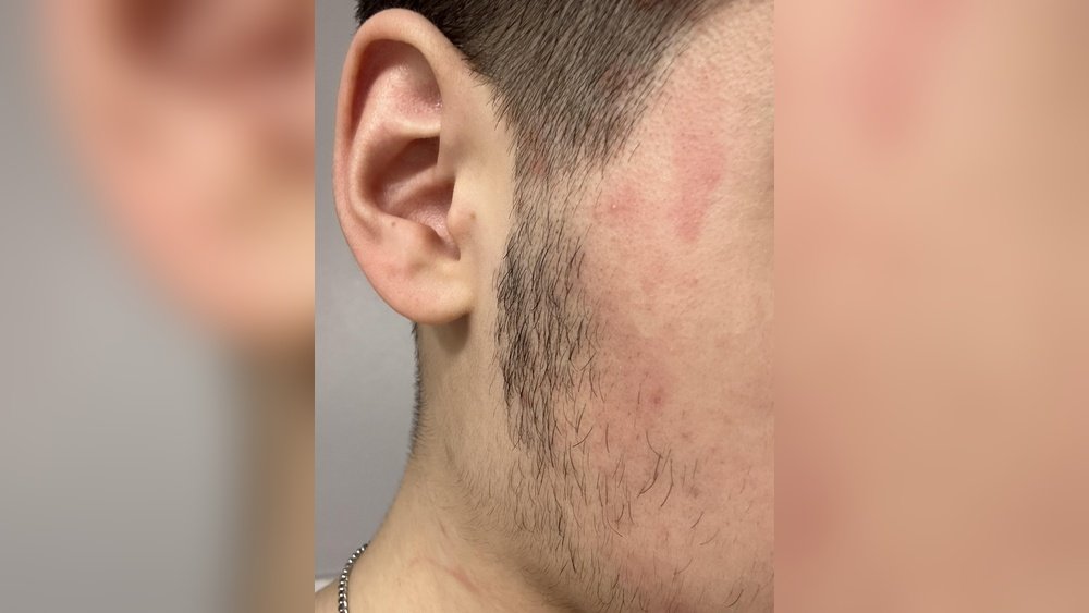 Why Do I Get Redness After Cleansing